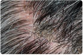 Scaly Scalp | MIMS online